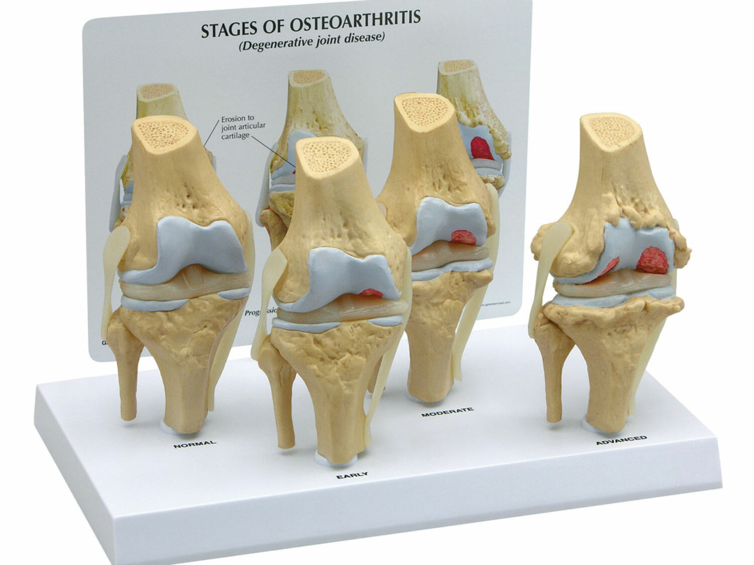 変形性膝関節症，4段階モデル | 日本スリービー・サイエンティフィック