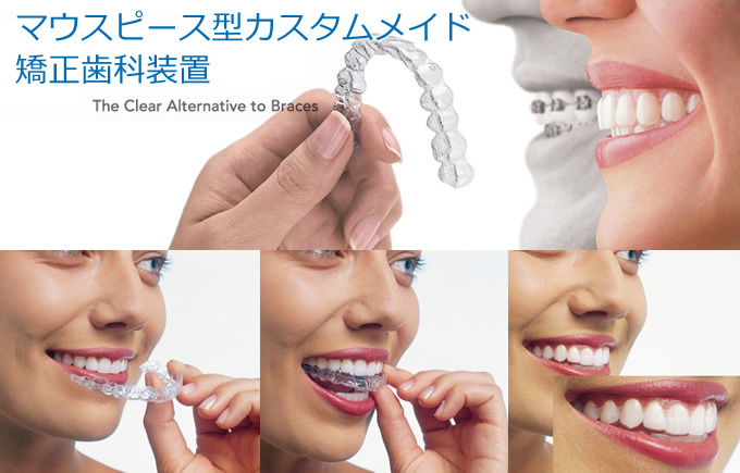マウスピース型矯正装置（インビザライン） | 鎌倉矯正歯科