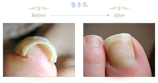 巻き爪補正コース プロ養成コース｜一般社団法人日本フットケア