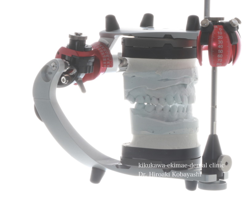 あなたのその治療計画は半調節性咬合器上で診査し計画されたものですか