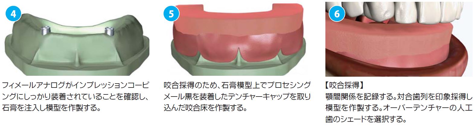 ロケーターアタッチメントシステム|株式会社インプラテックス