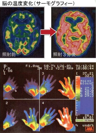 星状神経節照射｜スーパーライザー｜マーレあきら歯科クリニック｜武蔵