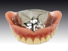 金属床義歯】自費診療の精密義歯｜堺（なかもず）の歯科・歯医者・矯正