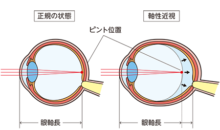 低濃度アトロピン点眼薬｜川崎市中原区-さこう眼科-小児眼科（近視