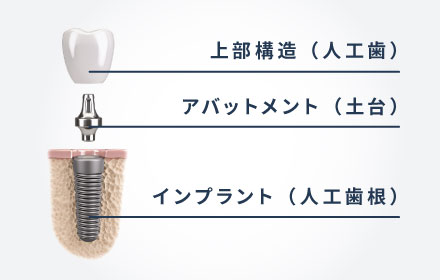 インプラント｜診療案内｜駿河区新川の歯科/歯医者【宇土歯科医院】