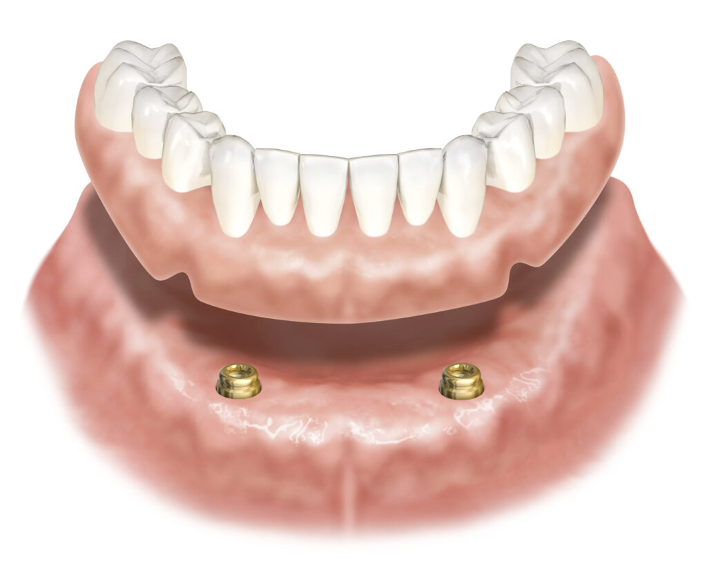 インプラント・ロケータ - 大阪府門真市にある堤デンタルクリニック