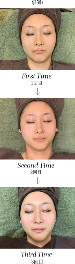 Needle peeling®｜株式会社アイセル｜ニードルピーリング・育肌ハーブ