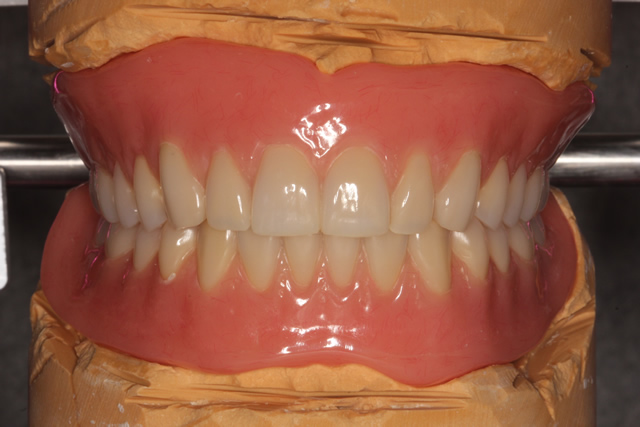 フルデンチャー | 取扱い技工物 | 歯科技工所 株式会社ジェネシス