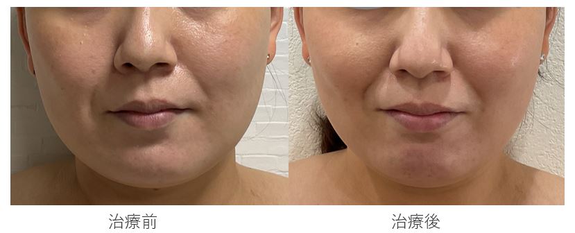 カベリン(脂肪溶解注射)は堺市の「 ひふみるクリニック」