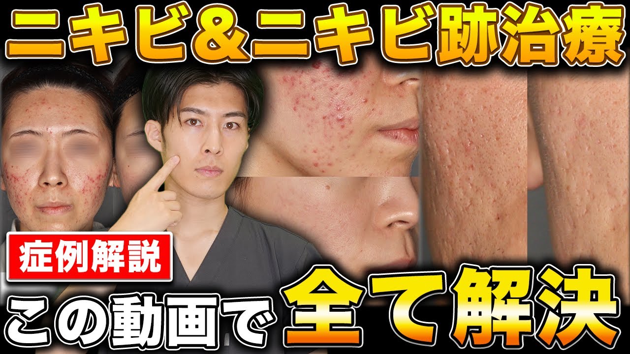 ニキビ跡を消す方法はある？クレーターにさよなら│SELECT CLINIC TIPS