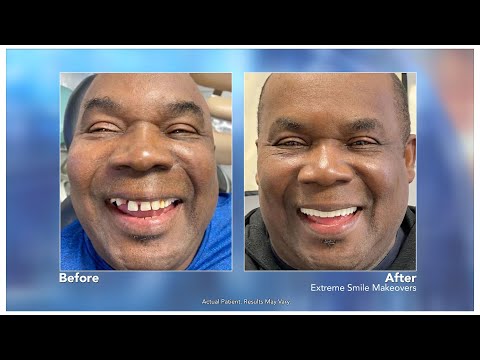 Extreme Smile Makeovers with Montclair, NJ dentist, Joseph Moussa